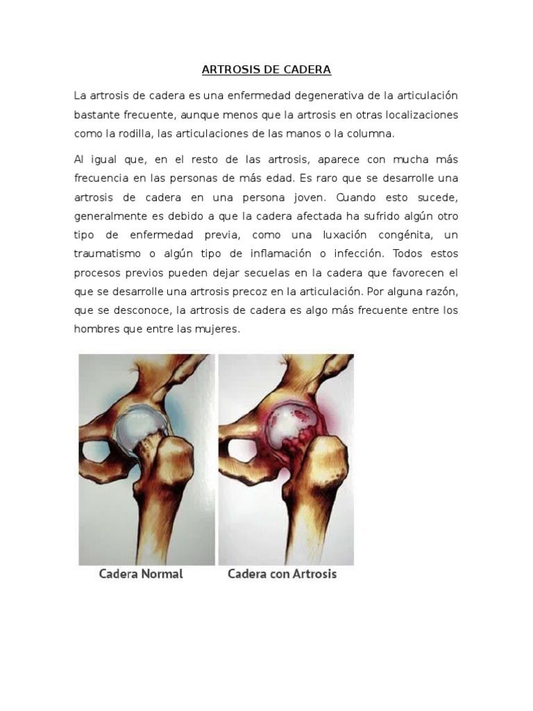 artrosis-de-cadera-s-ntomas-y-tratamiento-pdf-osteoartritis-rodilla