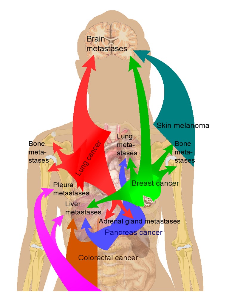 Diagram Metastases | PDF | Wellness | Computers