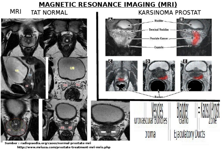 Normal Prostate MRI Insights | PDF | Science & Mathematics