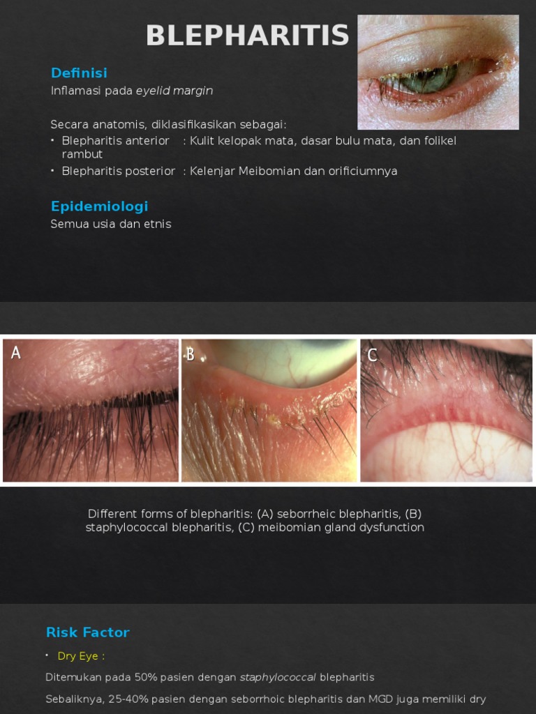 BLEPHARITIS | PDF