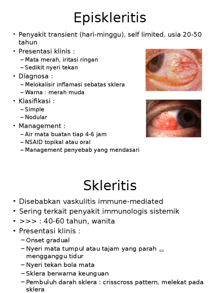 Episkleritis Dan Skleritis PDF