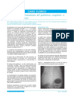Octreótide en Quilotórax Congénito PDF