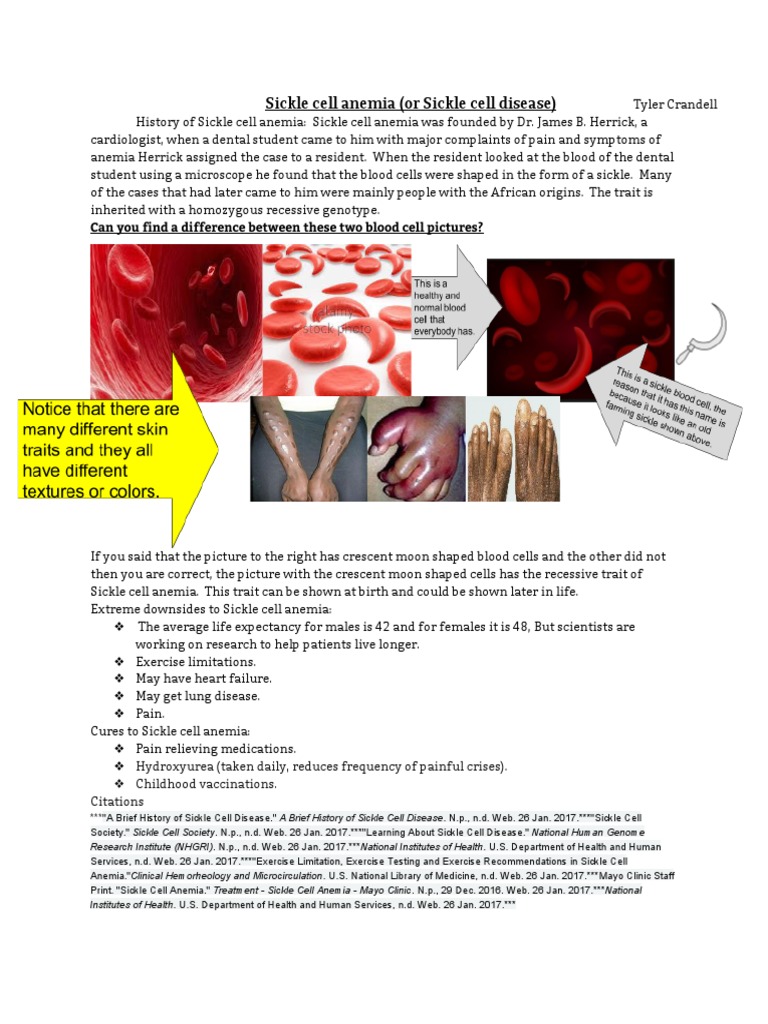 Understanding Sickle Cell Anemia | PDF | Sickle Cell Disease | Anemia