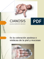 cianosis2