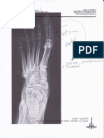 Osteotomia 1 Falange