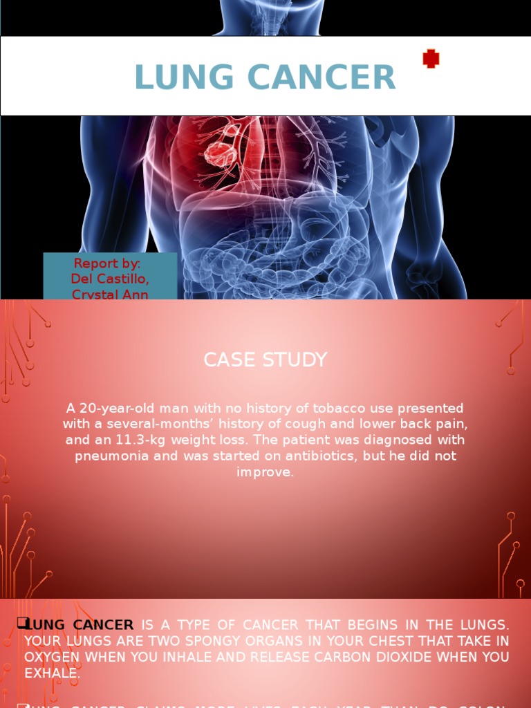 Lung Cancer | PDF