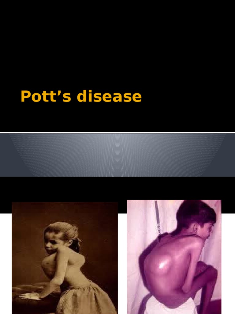 Pott S Disease PDF Vertebral Column Vertebra