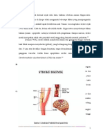 Stroke Iskemik