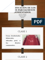 Clasificación de Los Arcos Parcialmente Desdentados 