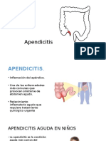 Apendicitis