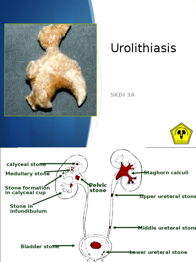 (2) Urolithiasis Genitourinary System Diseases Urology