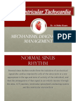 Supraventricular Tachycardia