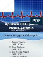 Ekg Aritmia