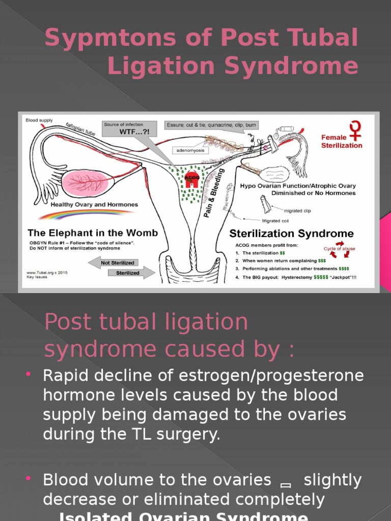Post Tubal Ligation Syndrome PDF