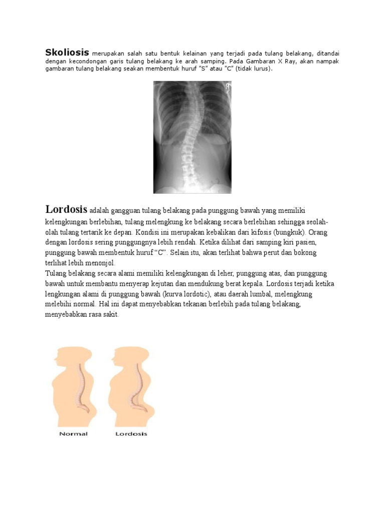 Skoliosis Adalah Salah Satu Bentuk Kelainan Pada Tulang