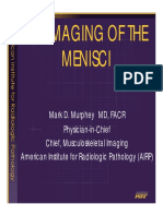 Ruptura Meniscal PDF