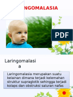 Laringomalasia