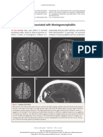 Zika Meningoensefalitis