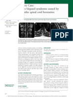 Brown-Séquard Syndrome Caused by Idiopathic Spinal Cord Herniation