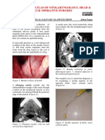 Ranula and Sublingual Salivary Gland Excision