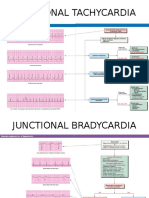 Junctional Rhythm