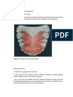 Mandibular Inclined Bite Plane