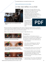 Community Eye Health Journal » How to Test for the Red Reflex in a Child 2014