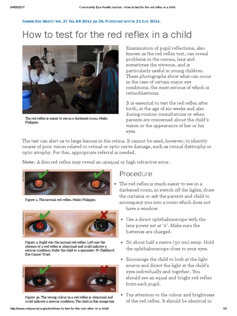 Community Eye Health Journal » How to Test for the Red Reflex in a