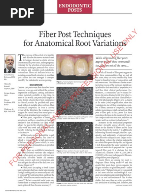 Fiber Post