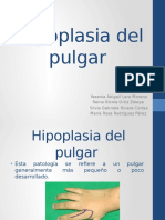 Pulgar corto: causas, grados e intervención quirúrgica