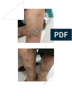 Neuro Dermatitis