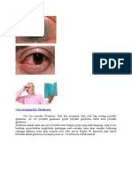 Ciri-Ciri Penyakit Glaukoma