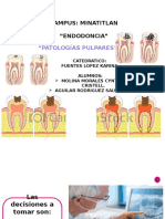 Endo Pulpitis