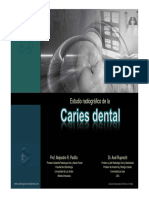 Estudio Radiográfico de La Caries Dental
