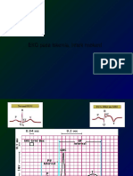 ekg II ACS