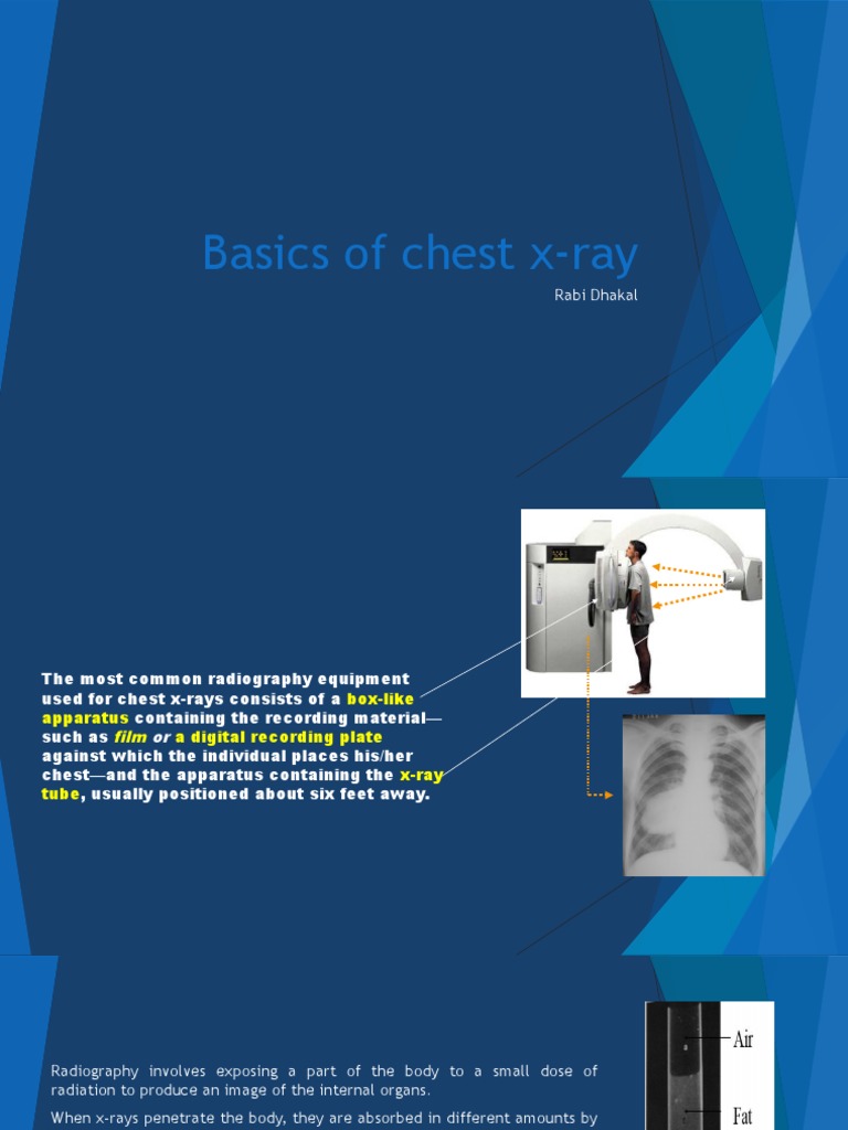 Basics of Chest XRay PDF Thorax Lung