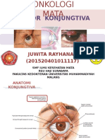 Juwita Rayhana (Tumor Konjungtiva)