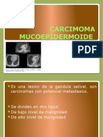 Carcimoma Mucoepidermoide