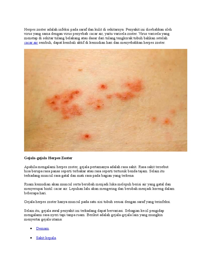 Herpes Zoster Adalah Infeksi Pada Saraf Dan Kulit Di Sekitarnya