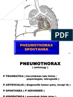 Pneumothorax