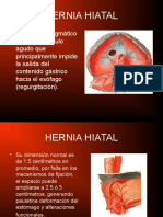 Hernia Hiatal