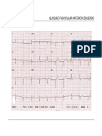 Bloqueo Fascicular Anterior Izquierdo PDF