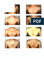 Acne Grading - Chest