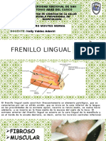 Frenilllo Lingual