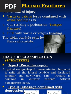 Bumper Fracture