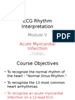 ECG Rhythm Interpretation: Acute Myocardial Infarction