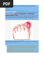 Cara Mengobati Cantengan Pada Jempol Kaki