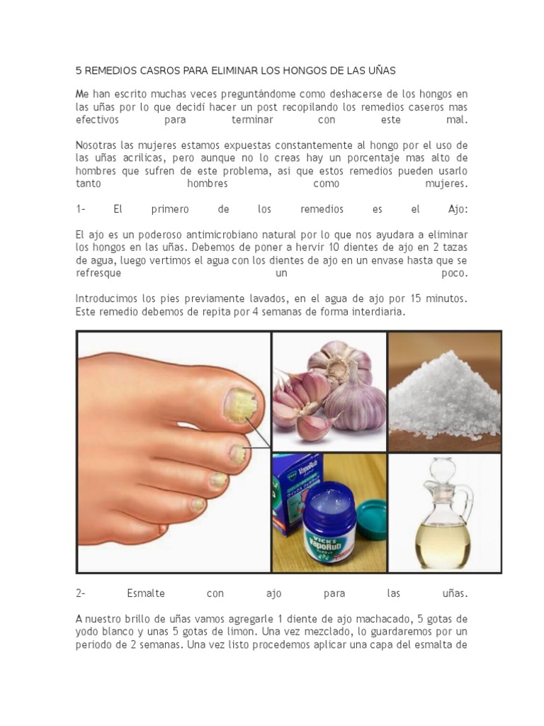 5 Remedios Casros para Eliminar Los Hongos de Las Uñas | PDF | Ajo | Clavo  (anatomía)