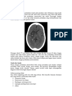 Stroke Hemoragik CT