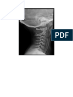 Spine Plain Radiograph
